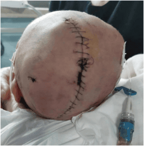 婴儿出生后颅骨骨折 医院回应