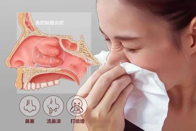 急性鼻炎发作怎么办