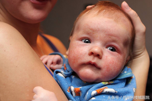 40多天的婴儿脸上湿疹怎么办