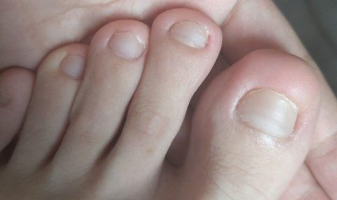 为什么年纪轻轻得了灰指甲-初中生得了灰指甲正常吗