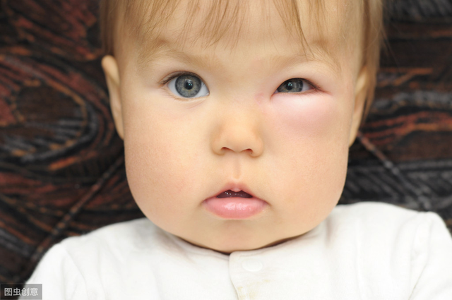 婴儿眼睛被蚊子咬肿了怎么办