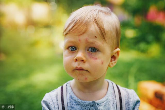 婴儿眼睛被蚊子咬肿了怎么办