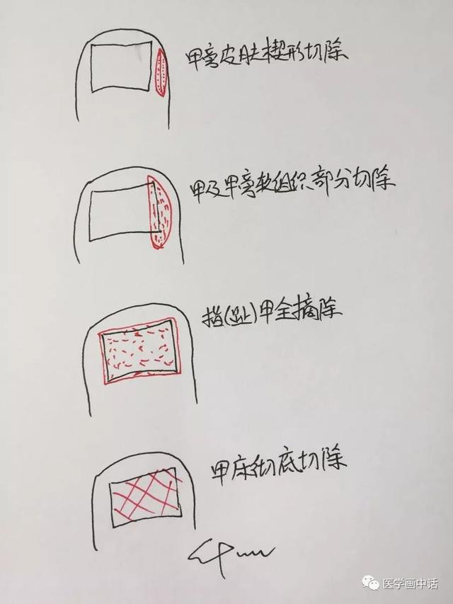 甲指炎怎么办